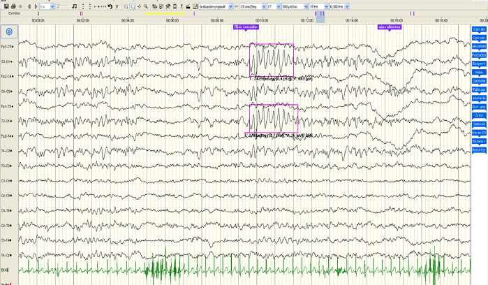 [Epilepsy in Angelman syndrome and the most common electroencephalographic findings].