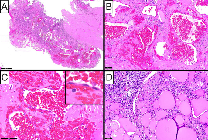 On Vascular Lesions of the Thyroid Gland with Emphasis on Intrathyroidal Hemangioma: Clinicopathologic Characterization of Two Cases and Review of the Literature.