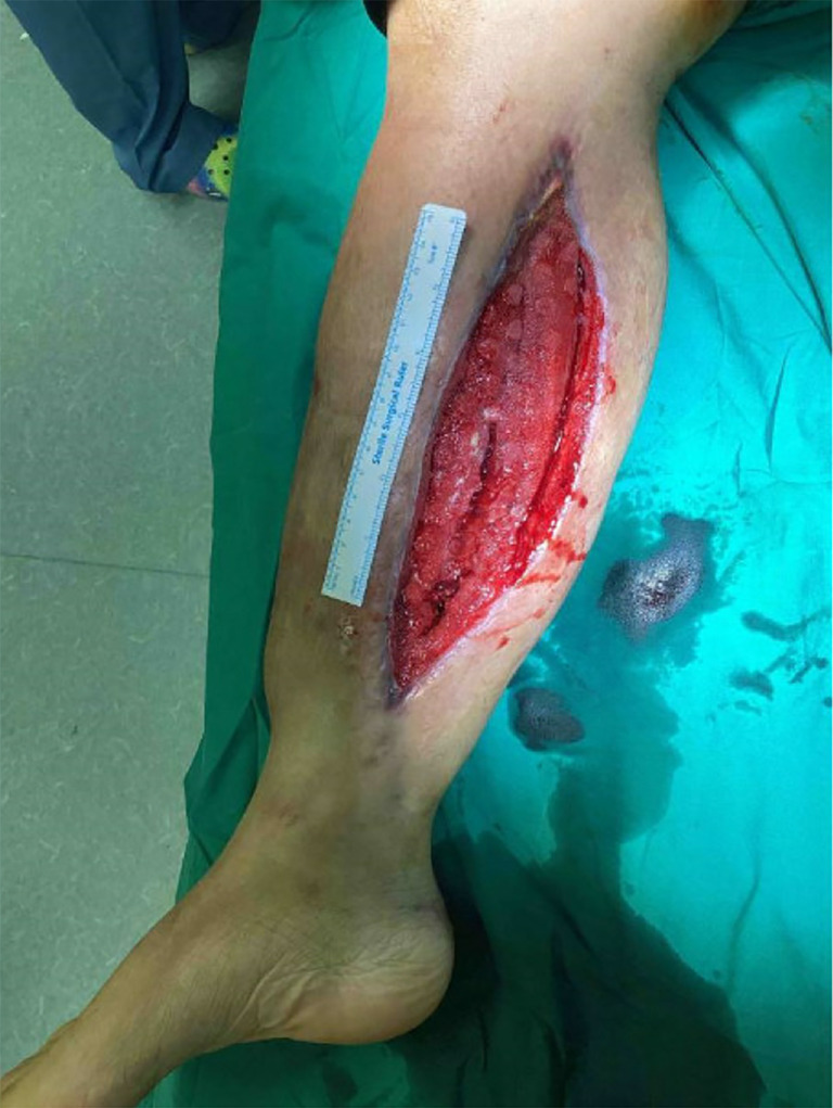 Expedited infection control and wound healing by combining Matriderm<sup>®</sup>, a dermal matrix, and Stimulan<sup>®</sup> absorbable antibiotic beads: a case report.