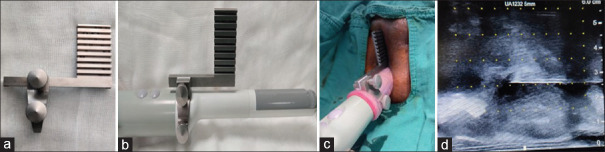 Factors influencing urinary retention following freehand transperineal prostate biopsy: Insights from a tertiary care center study.