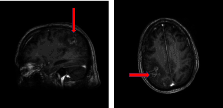 Late Relapse of Previous Pulmonary Cryptococcosis With Symptoms Resembling Cerebral Infarction: A Case Report.