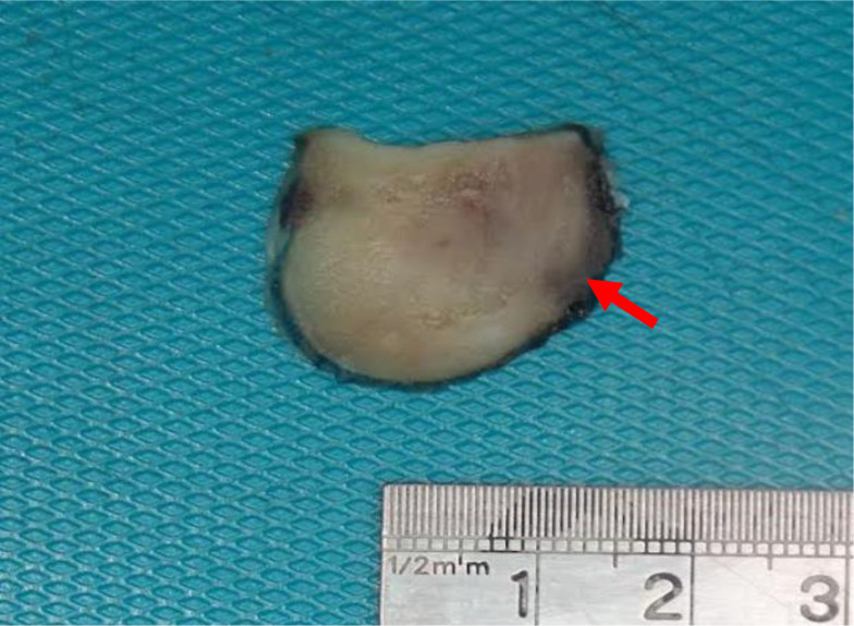 Papillary Thyroid Carcinoma with Fibromatosis/Fasciitis-Like/Desmoid-Type Stroma: Case Report of a Rare Subtype with Cytological and Molecular Study.