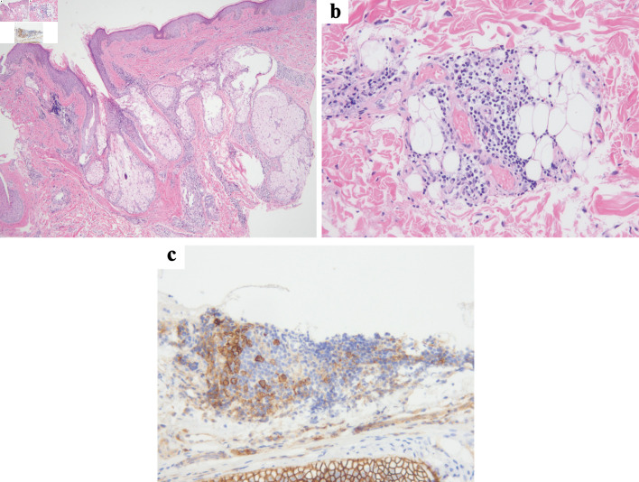 Successful Treatment of Idiopathic Multicentric Castleman Disease With Rash as the Initial Symptom Using a Rituximab-Based Regimen.