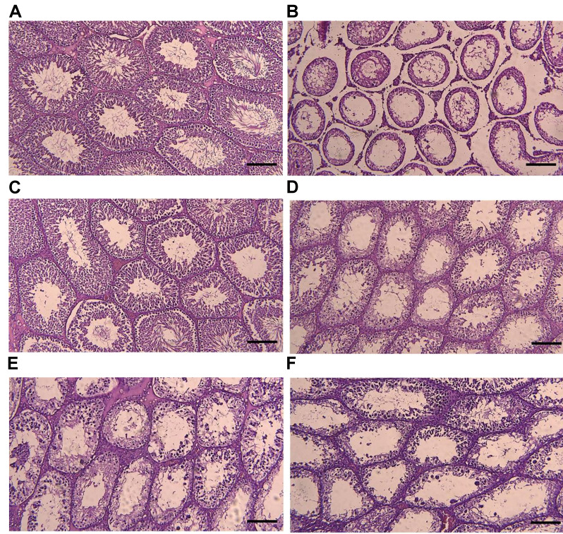 Nanocurcumin Decreases Nucleotide-Binding Oligomerization Domain-Like Receptor Family Pyrin Domain-Containing 3 Complex Expressions in An Experimental Testicular Torsion Model.
