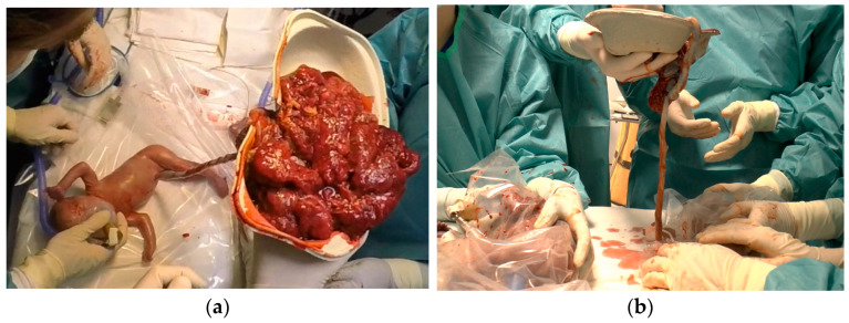 Selective Extrauterine Placental Perfusion in Monochorionic Twins Is Feasible-A Case Series.