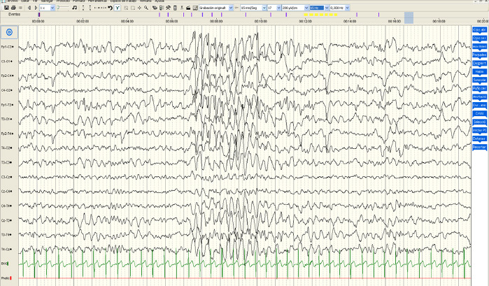 [Epilepsy in Angelman syndrome and the most common electroencephalographic findings].