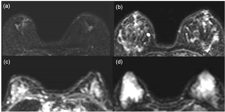 Diagnostic Utility of an Adjusted DWI Lexicon Using Multiple b-values to Evaluate Breast Lesions in Combination with BI-RADS.