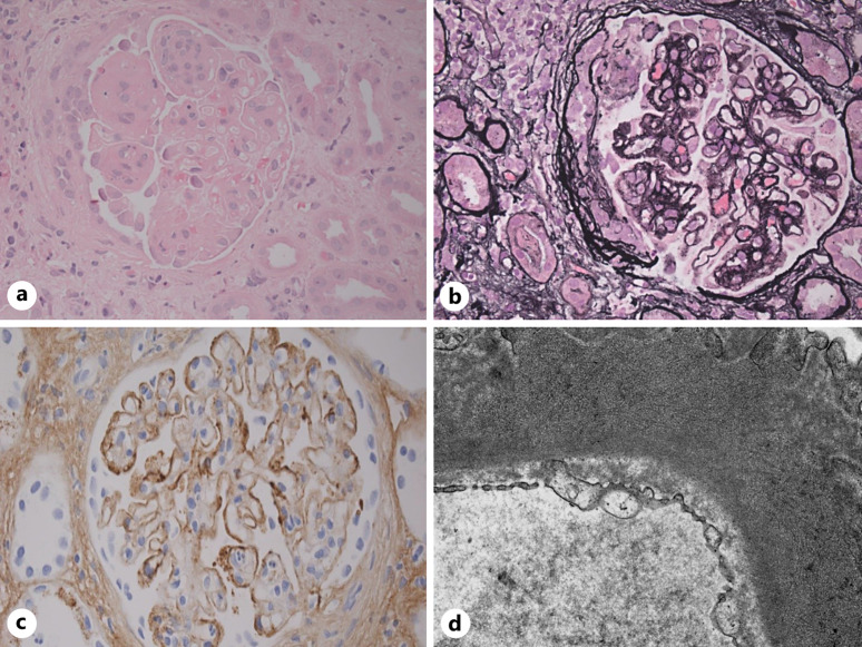 Recurrent Fibrillary Glomerulonephritis Secondary to Chronic Lymphocytic Leukemia: Remission of Kidney Disease with Ibrutinib.