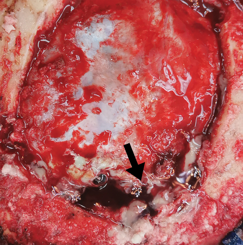 Superior Sagittal Sinus Thrombosis Secondary to Cerebral Aspergillosis with Ventriculitis in an Immunocompetent Patient: A Case Report.