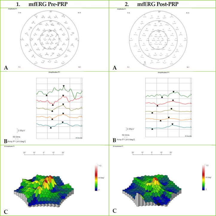 Multifocal electroretinogram changes after panretinal photocoagulation in early proliferative diabetic retinopathy.