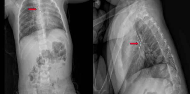 A Rare Case of a Child with Bended Scarf-Pin in Left Bronchus: Case Report with Systematic Review And Meta-Analysis.