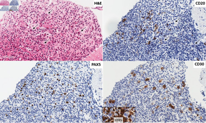 Primary Refractory Discordant Diffuse Large B-Cell and Classical Hodgkin Lymphoma.