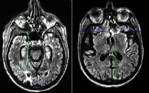 Myxedema Coma as a Presentation of Panhypopituitarism Secondary to Traumatic Brain Injury.