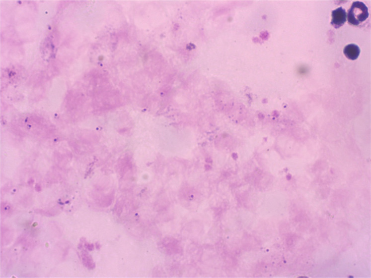 Acute Kidney Failure Confused with Thrombocytopenic Thrombocytic Purpura in Malaria: A Case Report.