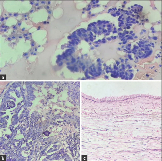 Primary Peritoneal Serous Carcinoma with Coexistent Mucinous Cystadenoma of Ovary - A Rare Case Report.
