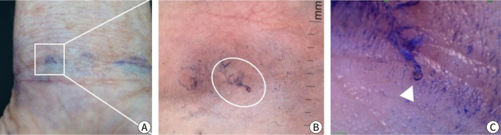 Clinical practice guidelines for the diagnosis and treatment of scabies in Korea: Part 1. Epidemiology, clinical manifestations, and diagnosis - a secondary publication.