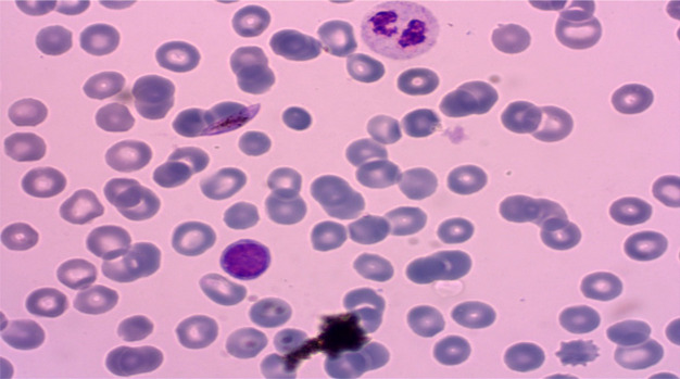 Acute Kidney Failure Confused with Thrombocytopenic Thrombocytic Purpura in Malaria: A Case Report.