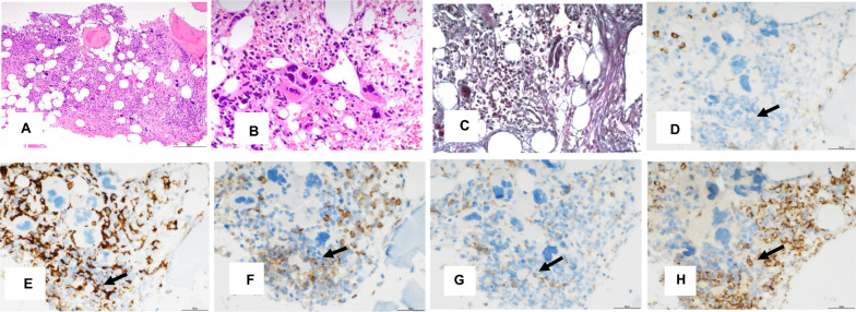 Triple immunostaining demonstrates the possible existence of segregated-nucleus-containing atypical monocytes in human primary myelofibrosis bone marrow: a case report.
