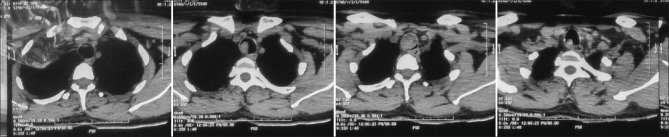 The Shared Airway: Tracheal Mass Excision.