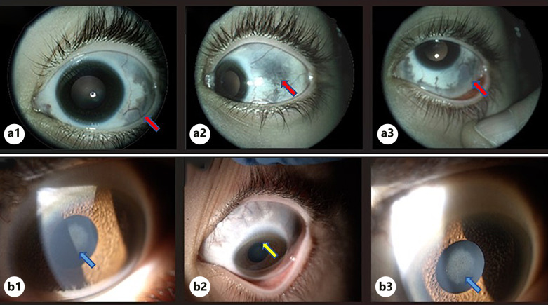 Wilson's Disease and Nevus of Ota in a Child: A Case Report.