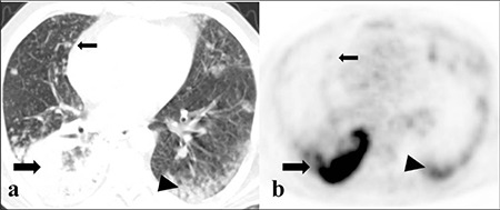 Impacts of <sup>18</sup>F-FDG PET/CT Parameters on Differential Diagnosis and Outcome of Patients with Primary Invasive Mucinous and Lepidic Predominant Adenocarcinoma of the Lung.