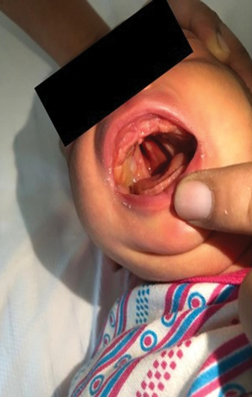 Cleft Palate-Lateral Synechiae Syndrome: A Case Report.