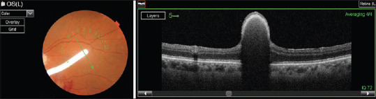 Foveal adhesion of a dexamethasone implant: Evaluation and follow-up via multimodal imaging.