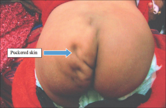 Presacral Keratinous and Dermoid Cyst Masquerading as Meningocele - A Rare Case Report.