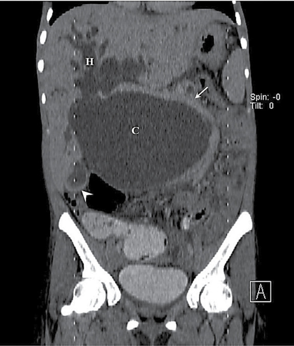 Huge Choledochal Cyst in a 26-Year-Old Female: A Case Report.