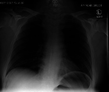 Clinical Challenges and Surgical Interventions in Managing Neck Hematoma After Cervical Spine Fusion: A Case Report.