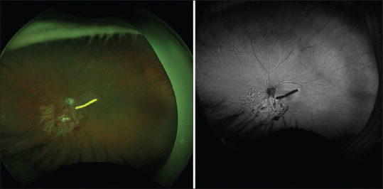 Foveal adhesion of a dexamethasone implant: Evaluation and follow-up via multimodal imaging.