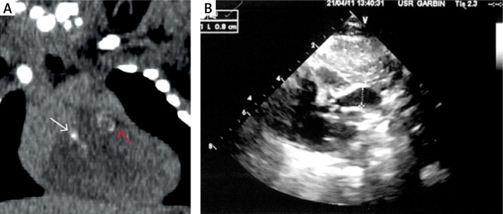 Generalized arterial calcifications in a twin recipient treated with etidronate: description of a case report within a narrative review.