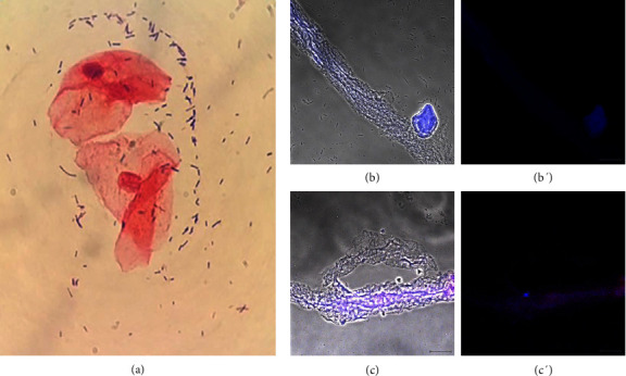 Extracellular Traps in Patients Diagnosed With Bacterial Vaginosis, Trichomoniasis, Candidiasis, Noninfectious Vaginitis and Cytolytic Vaginosis.