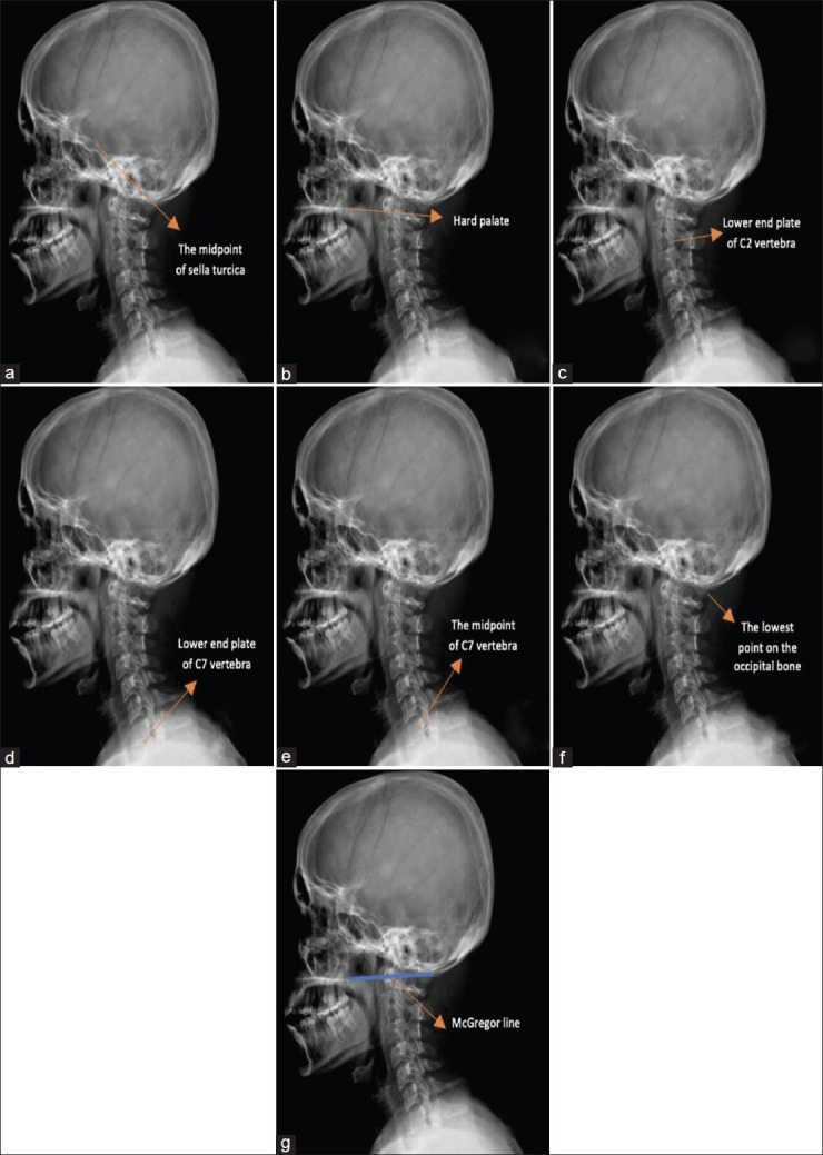 The head position and cervical alignment in patients with Chiari malformation: A retrospective case-control study.