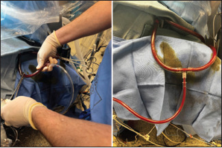 Maintaining a Bloodless Field for HeartMate 3 Placement: Splicing an RVAD Outflow Cannula into the CPB Venous Reservoir for Complete LV Emptying.