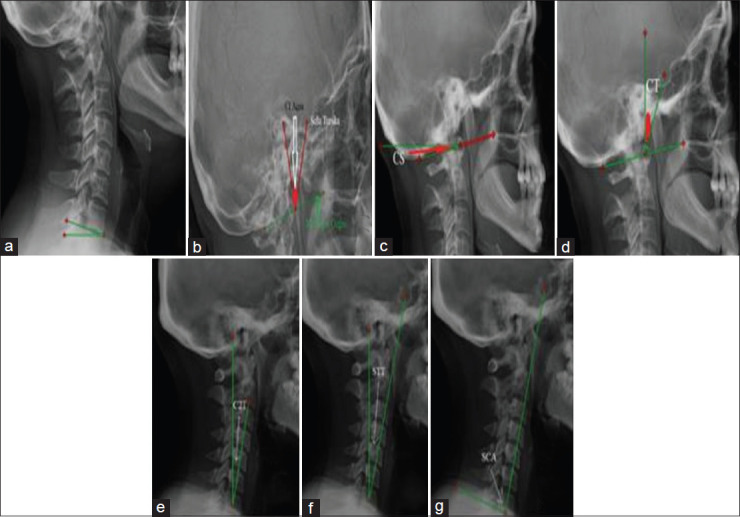 The head position and cervical alignment in patients with Chiari malformation: A retrospective case-control study.
