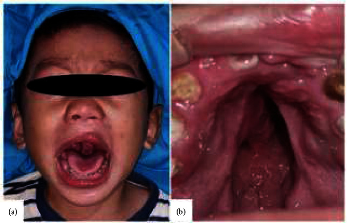 Honey as an Alternative Dressing in Post-Palatoplasty-Two Case Reports.