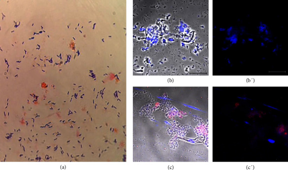 Extracellular Traps in Patients Diagnosed With Bacterial Vaginosis, Trichomoniasis, Candidiasis, Noninfectious Vaginitis and Cytolytic Vaginosis.