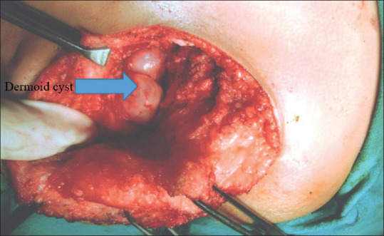 Presacral Keratinous and Dermoid Cyst Masquerading as Meningocele - A Rare Case Report.