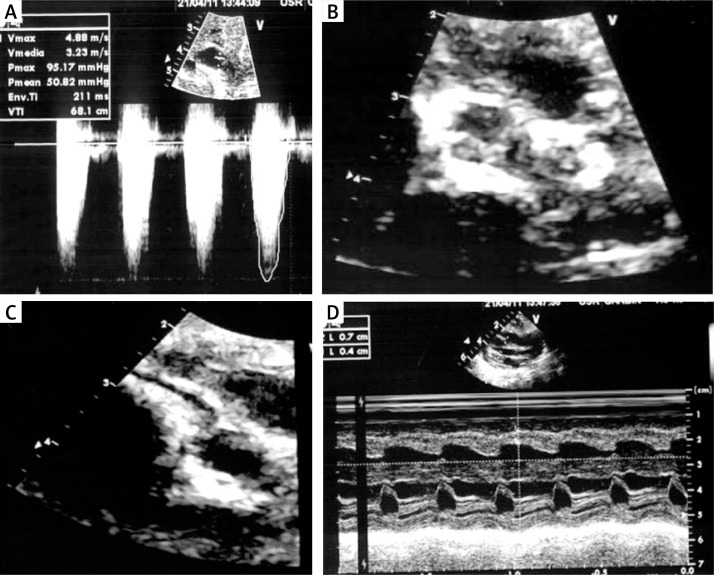 Generalized arterial calcifications in a twin recipient treated with etidronate: description of a case report within a narrative review.