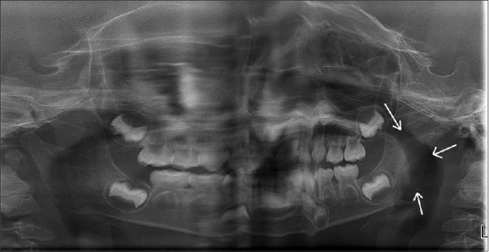 Atypical jaw swelling in children: An unusual clinical spectrum of Langerhans cell histiocytosis.