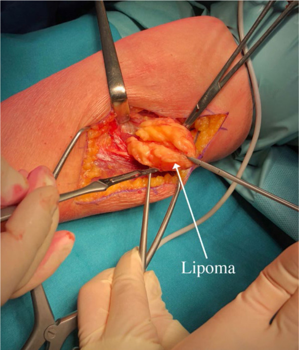 Posterior interosseous nerve lesion due to lipoma. Review of the literature and rare case presentation.