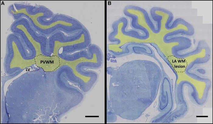 White matter protection with insulin-like growth factor-1 after hypoxia-ischaemia in preterm foetal sheep.