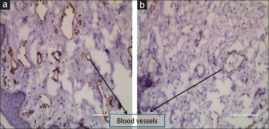 Effect of Pre-operative Parenteral Testosterone on Penile Dimensions and Vascularity in Proximal Hypospadias: A Prospective Observational Study.