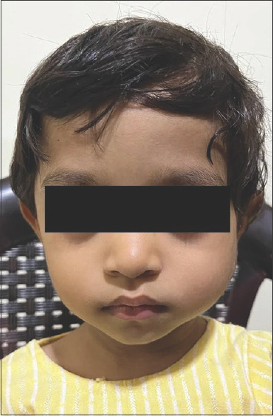 Atypical jaw swelling in children: An unusual clinical spectrum of Langerhans cell histiocytosis.
