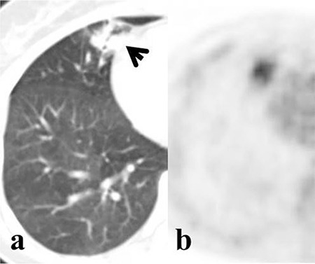 Impacts of <sup>18</sup>F-FDG PET/CT Parameters on Differential Diagnosis and Outcome of Patients with Primary Invasive Mucinous and Lepidic Predominant Adenocarcinoma of the Lung.