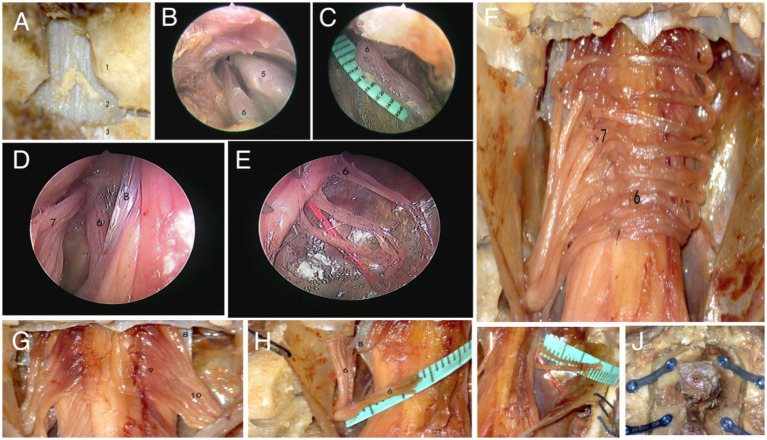 Anatomical study of single incision contralateral C7 nerve transfer through subdural pathway.