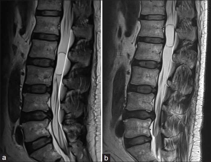 Mobile schwannomas of the spine: Diagnostic and surgical considerations of two cases.