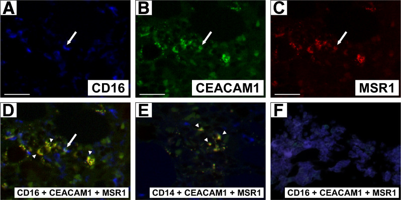 Triple immunostaining demonstrates the possible existence of segregated-nucleus-containing atypical monocytes in human primary myelofibrosis bone marrow: a case report.