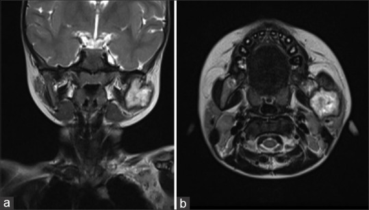Atypical jaw swelling in children: An unusual clinical spectrum of Langerhans cell histiocytosis.